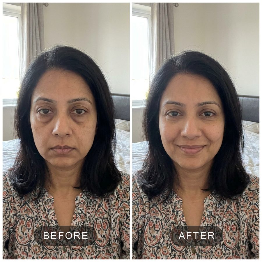 Before and after under-eyes